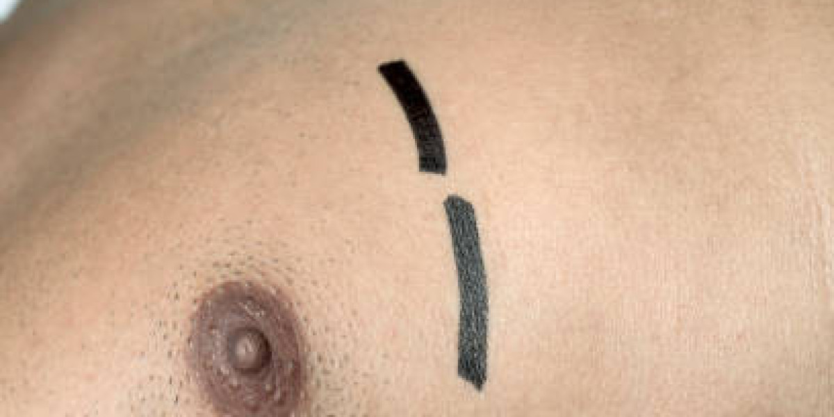 How Gynecomastia Surgery Can Help Men Achieve a Masculine Chest in Riyadh