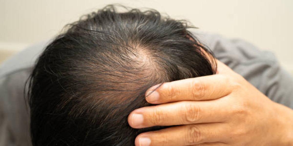 Exosomes Therapy for Hair Loss and Hair Wellness Benefits